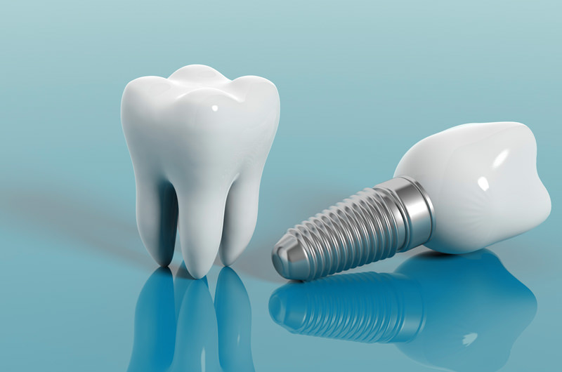 インプラントとは