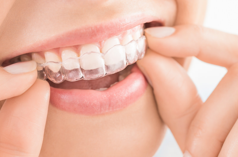 マウスピースとは